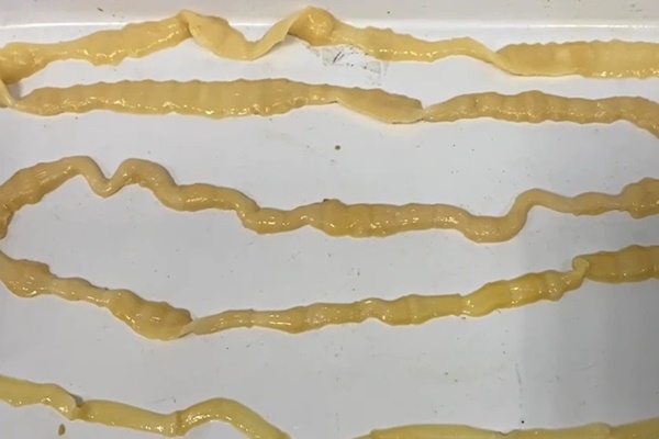 Hà Nội: Thích ăn phở tái, cô gái có sán 6m ngọ nguậy trong người-1