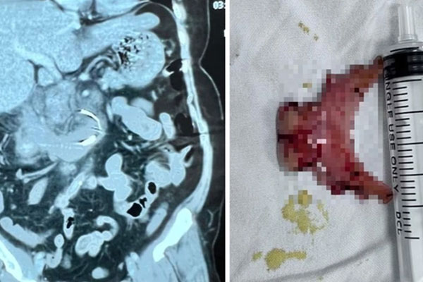 Vệ sinh răng, người phụ nữ nuốt luôn hàm răng giả-1