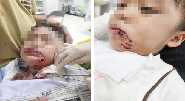 Đi du lịch cùng gia đình, cháu bé 3 tuổi bị chó cắn phải khâu 32 mũi-2