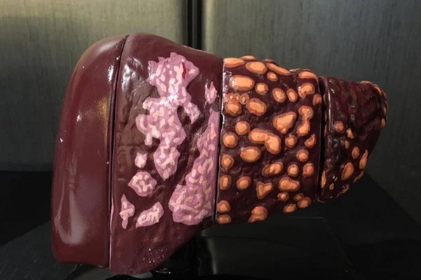 Chuyên gia dinh dưỡng tiết lộ cách hồi sinh lá gan nhờ 7 loại thực phẩm đơn giản-1