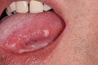 Đi khám vì có dấu hiệu lạ trong miệng, không ngờ nguyên nhân là ung thư