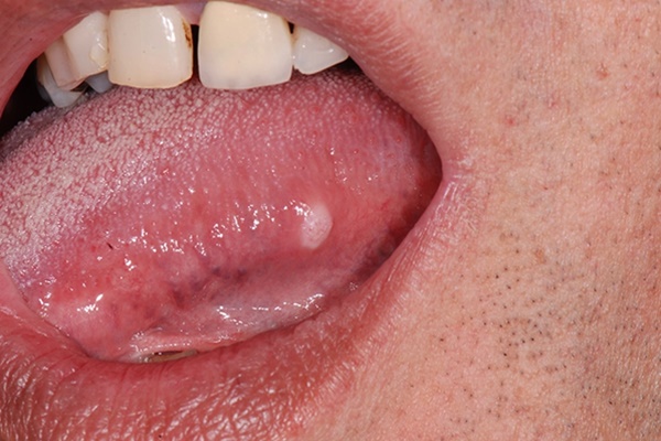 Đi khám vì có dấu hiệu lạ trong miệng, không ngờ nguyên nhân là ung thư-1