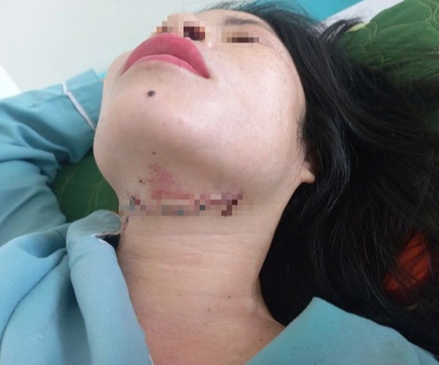 Chém vợ cũ gần đứt chân, con trai vào can cũng bị chém-2