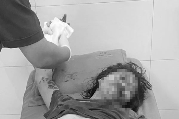 Điện thoại phát nổ khi đang sạc pin, một phụ nữ bị dập nát bàn tay-1