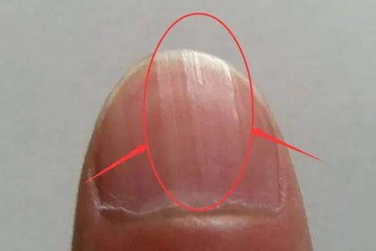 Bác sĩ cảnh báo trên móng tay có dấu hiệu này cần cẩn trọng với 5 loại bệnh, nên đi khám càng sớm càng tốt