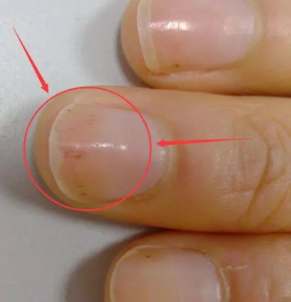 Bác sĩ cảnh báo trên móng tay có dấu hiệu này cần cẩn trọng với 5 loại bệnh, nên đi khám càng sớm càng tốt-3