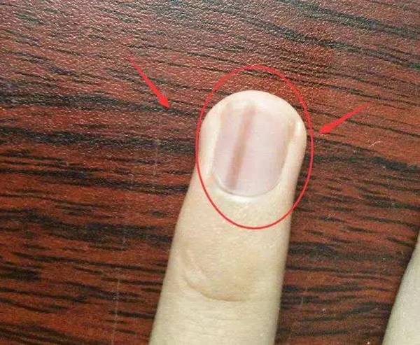 Bác sĩ cảnh báo trên móng tay có dấu hiệu này cần cẩn trọng với 5 loại bệnh, nên đi khám càng sớm càng tốt-4