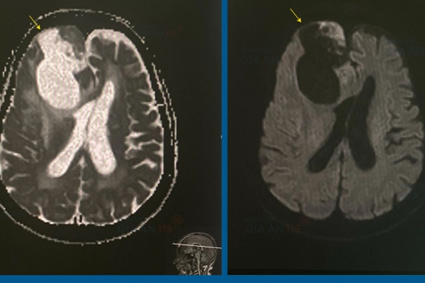 4 giờ cân não để phẫu thuật khối u não khổng lồ cho cụ bà 83 tuổi-1