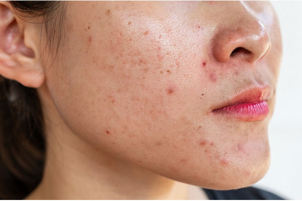 4 bước skincare cần làm ngay khi da có mụn-1