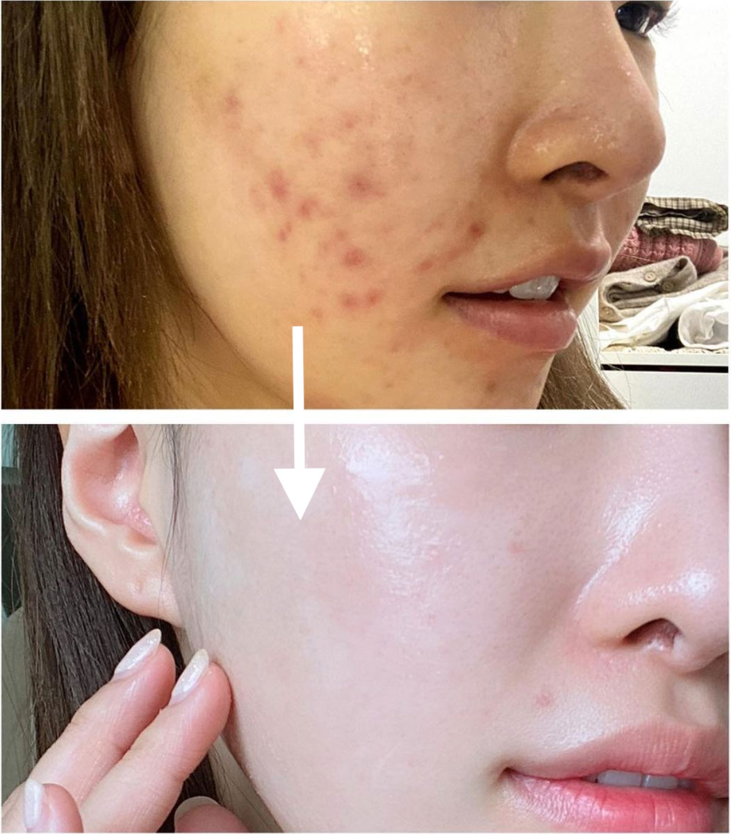 4 bước skincare cần làm ngay khi da có mụn-2