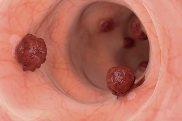 Thói quen xấu khiến nguy cơ mắc ung thư đại tràng tăng vọt: Nhiều người có mà không biết-1