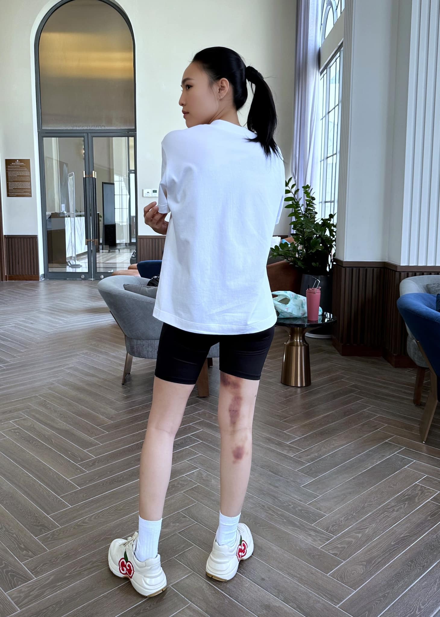 Ninh Dương Lan Ngọc khiến khán giả lo lắng khi lộ vết bầm tím lớn ở chân-1