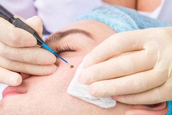 Xóa nốt ruồi bằng phương pháp laser có sợ nguy cơ bị ung thư?-2