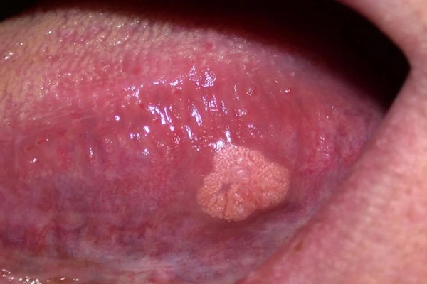 Loại ung thư khiến người bệnh không thể ăn uống, hơi thở có mùi nồng nặc-2