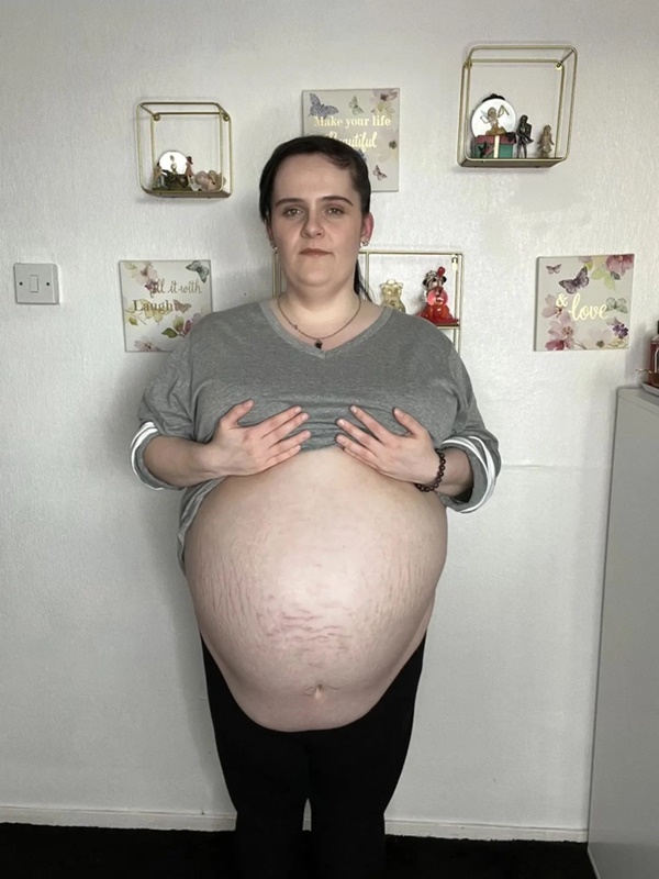Tưởng mang thai, người phụ nữ không ngờ mình bị u nang buồng trứng nặng 16kg-1
