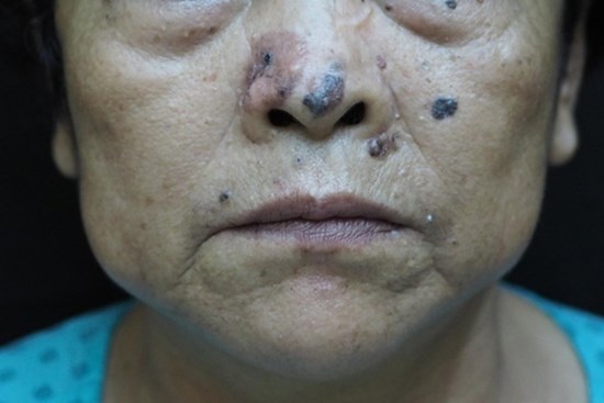 Loại ung thư ác tính, xuất hiện ở cả miệng và cơ quan sinh dục