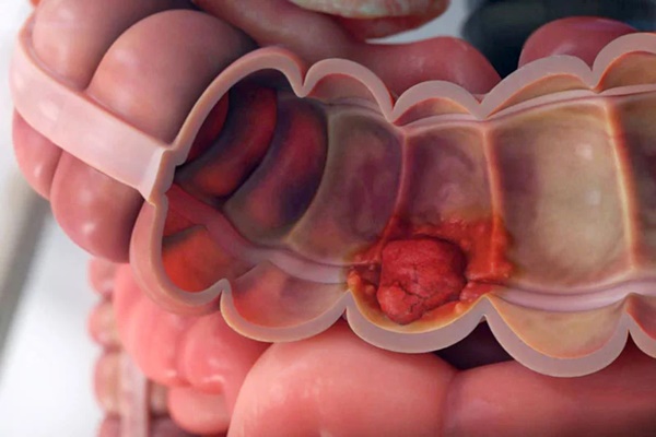 Ung thư ruột giai đoạn đầu thường có 3 tín hiệu dễ nhầm lẫn-1