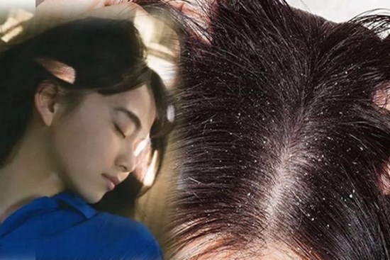 1 dấu hiệu ung thư da đầu rất giống với gàu, chủ quan bỏ qua dễ khiến bệnh nặng khó chữa