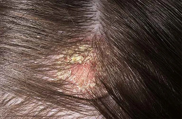 1 dấu hiệu ung thư da đầu rất giống với gàu, chủ quan bỏ qua dễ khiến bệnh nặng khó chữa-1