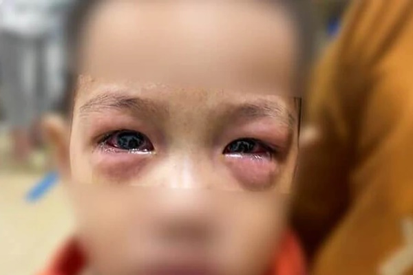 Cảnh báo dịch viêm kết mạc cấp do virus đang lây lan nhanh, diễn biến phức tạp-1