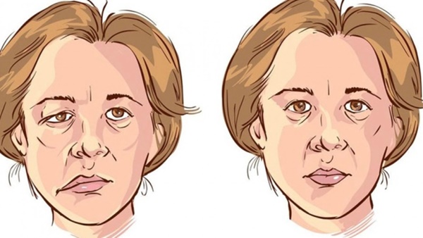 Hari Won từng bị liệt nửa mặt, tự ti không dám xuất hiện: Cảnh báo dấu hiệu bệnh và thời điểm dễ bị-3