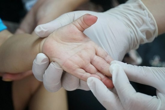 Đắk Lắk ghi nhận trường hợp thứ 2 tử vong vì bệnh tay chân miệng