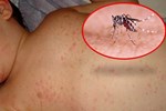 Hà Nội ghi nhận 2 ca tử vong đầu tiên trong năm nay vì sốt xuất huyết-1