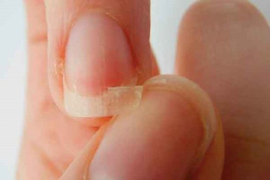 Móng tay bỗng nổi đốm trắng, sần sùi, dễ gãy cảnh báo bất ổn sức khỏe gì?