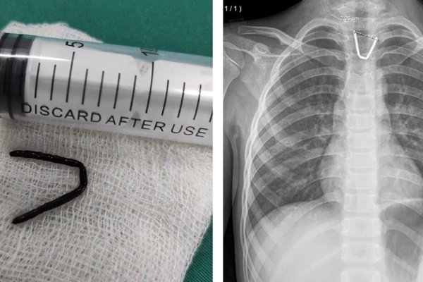 Lấy dị vật kim khí hình chữ U trong thực quản bé 8 tuổi-1