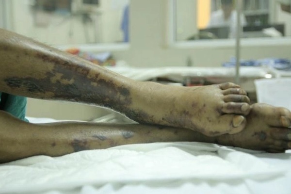 Nhiễm liên cầu lợn vì mê món đặc sản-2