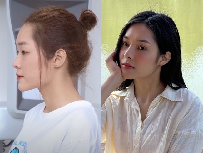 Á hậu Hồng Hạnh của Miss Grand Vietnam 2023: Sửa mũi, nhấn mí, tiêm filler để có nhan sắc chuẩn beauty queen-8