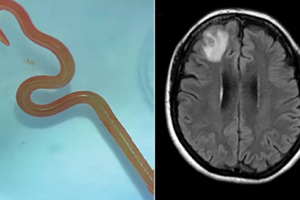 Gắp con giun còn sống ngoe nguẩy trong não người phụ nữ-1