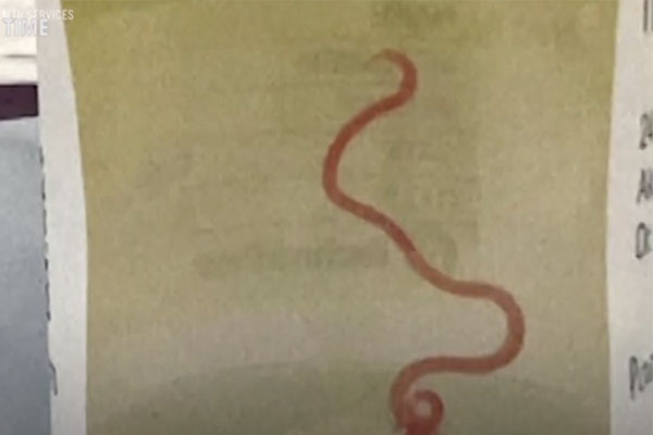 Cô gái 21 tuổi bị sán bám đặc gan, nguyên nhân từ 2 thói quen nhiều người mắc-5