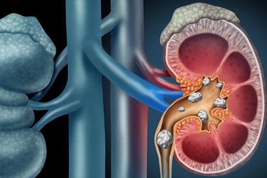 5 loại thực phẩm dễ tạo sỏi thận nếu ăn nhiều