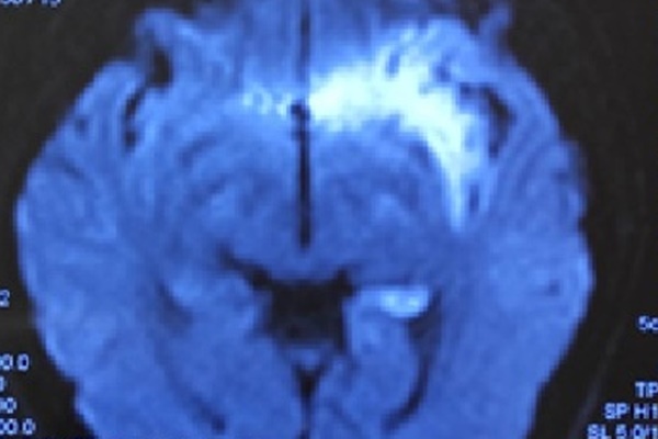 Bé trai mắc di chứng nặng nề của viêm não Nhật Bản-1