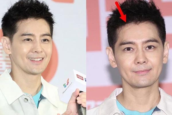 Xót xa hình ảnh Lâm Chí Dĩnh lộ khuôn mặt lồi lõm sau tai nạn xe nghiêm trọng-6