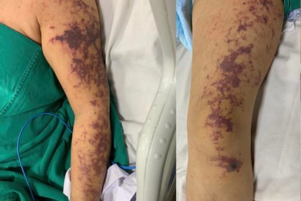 Đi chung dép, gia đình 4 người bị nổi mụn hạt cơm ở bàn chân-2