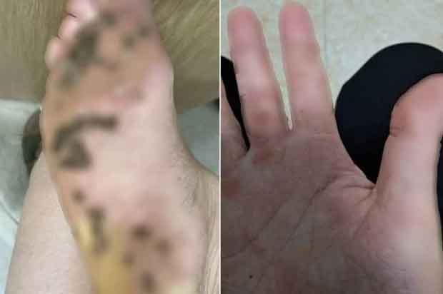 Đi chung dép, gia đình 4 người bị nổi mụn hạt cơm ở bàn chân-1