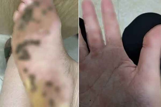 Đi chung dép, gia đình 4 người bị nổi mụn hạt cơm ở bàn chân