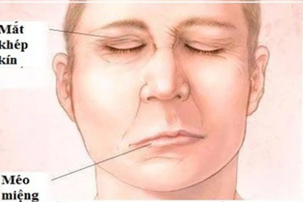 Bé 9 tuổi bị liệt nửa người sau khi vỡ mạch máu não-1