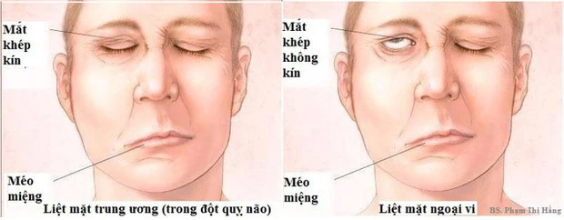 Trúng gió và đột quỵ não thường bị nhầm lẫn, phân biệt ra sao để có cách xử trí đúng?-1