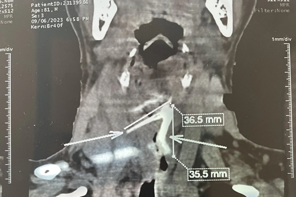 Một tháng sau khi ăn cá, người đàn ông suýt tử vong-3