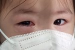 Bác sĩ: Cần phân biệt đau mắt đỏ do virus hay vi khuẩn, có các triệu chứng sau phải đi khám ngay-3