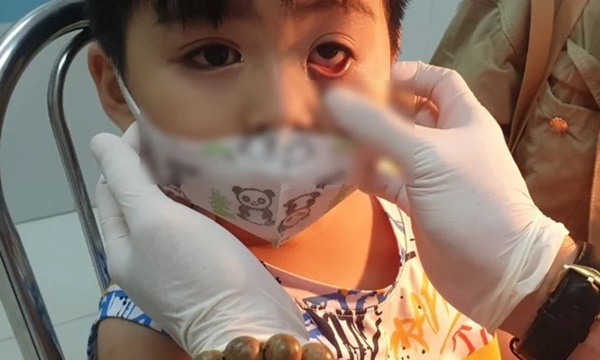 Trẻ mầm non đi học giữa mùa dịch đau mắt đỏ: Bác sĩ khuyên những việc cần làm để phòng bệnh-1
