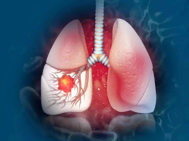 Dấu hiệu cảnh báo ung thư phổi có thể xuất hiện vào buổi sáng: Số 3 65% người mắc đều có-1