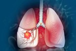 Cách nhận biết dấu hiệu khi ho cảnh báo nguyên nhân do ung thư phổi-4