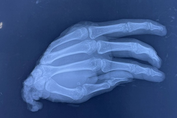 TPHCM: Chàng trai nhập viện lúc 0h với bàn tay đứt lìa bỏ vào thùng nước đá-1