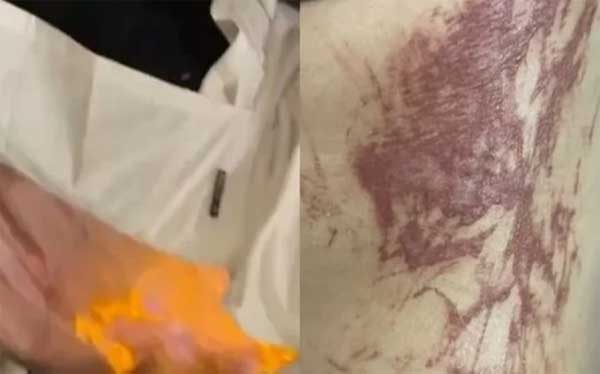 Đòi đầu bếp múa lửa tại bàn để quay clip, cô gái bị bỏng nặng-1