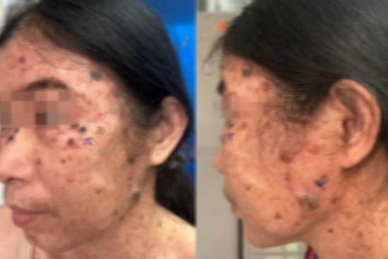 Ca bệnh hiếm gặp: Loạn sản thượng bì dạng hạt cơm tiến triển thành đa ung thư da