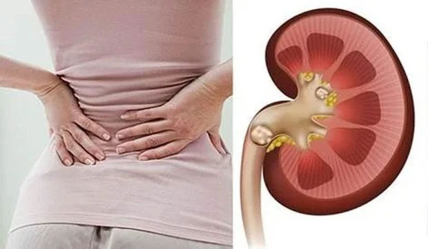 Thói quen tưởng vô hại nhưng lại là nguyên nhân khiến thận chứa cả túi sỏi-1